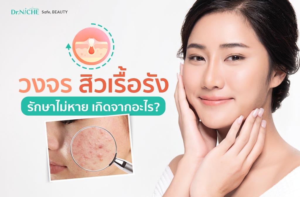 วงจรสิวเรื้อรัง รักษาไม่หาย เกิดจากอะไร?