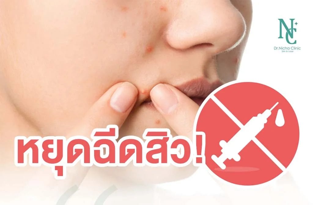 ฉีดสิวบ่อยๆ สาเหตุผิวเสียแบบไม่รู้ตัว