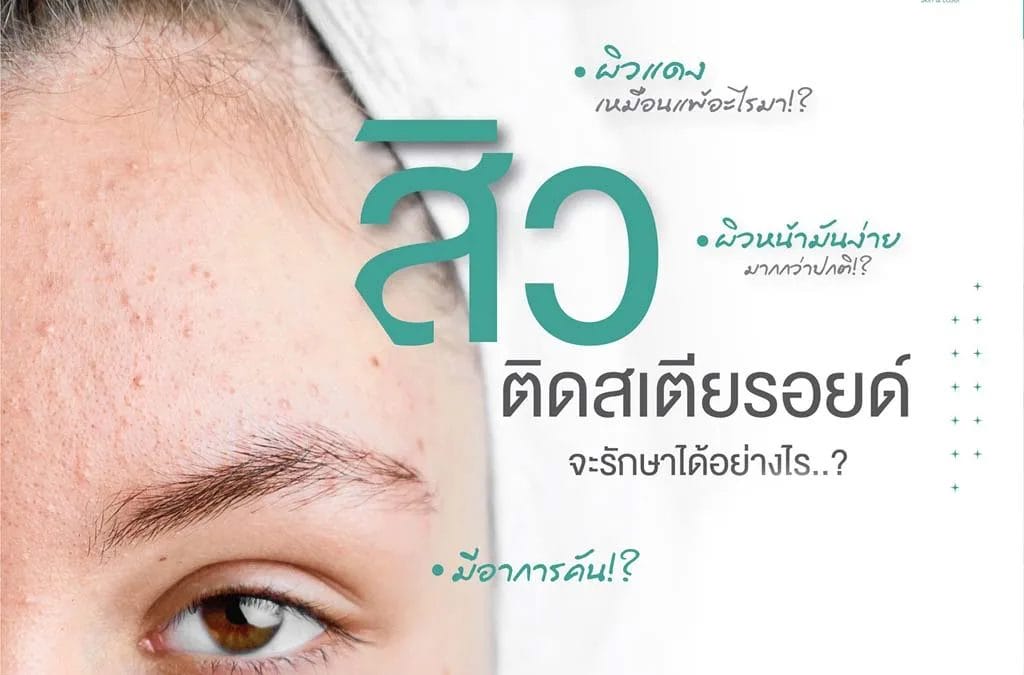 สิวสเตียรอยด์ จุดเริ่มต้นของปัญหาสิวเรื้อรัง