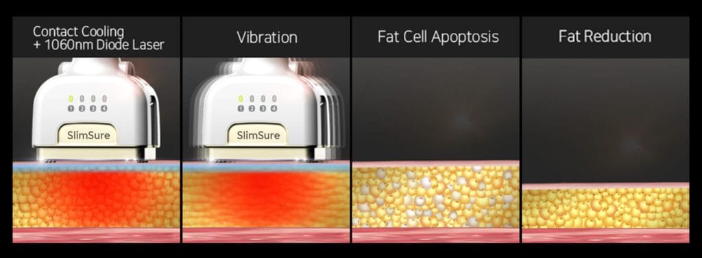 Fat Reduction Fat Reduction