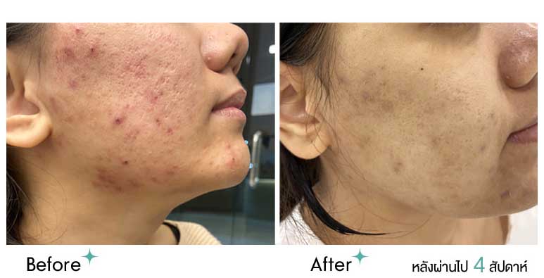 Acne case 2