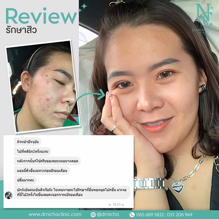 Acne case 3