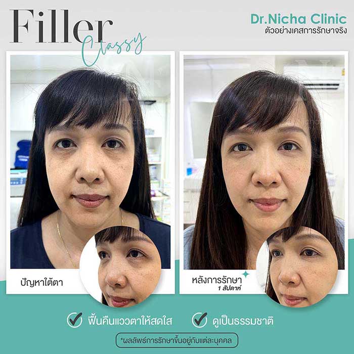 Filler Eyes case 1