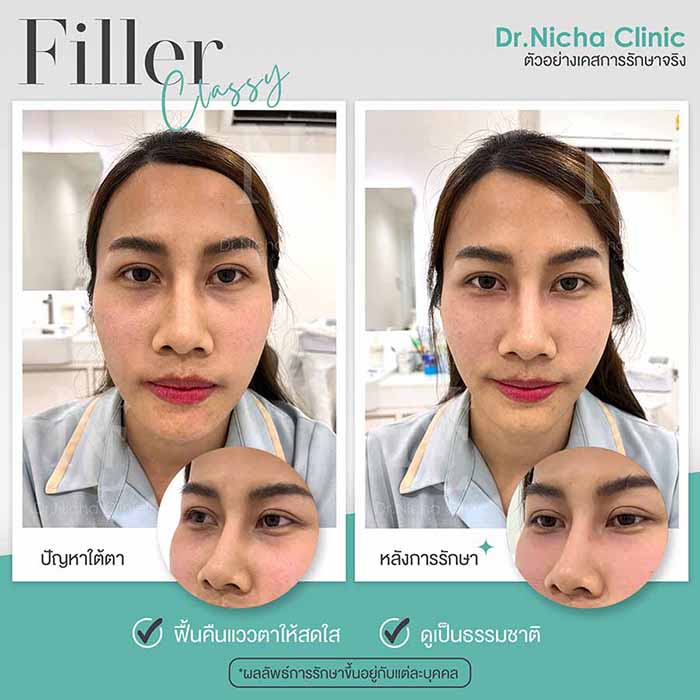 Filler Eyes case 10