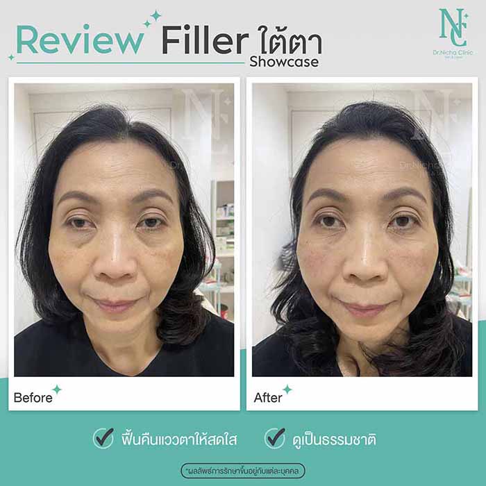 Filler Eyes case 2