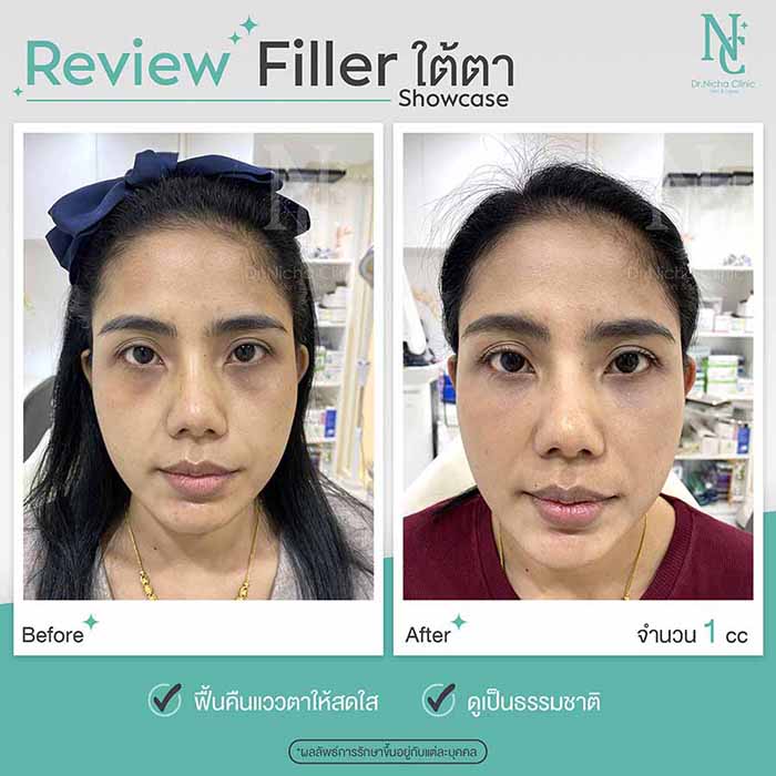 Filler Eyes case 3