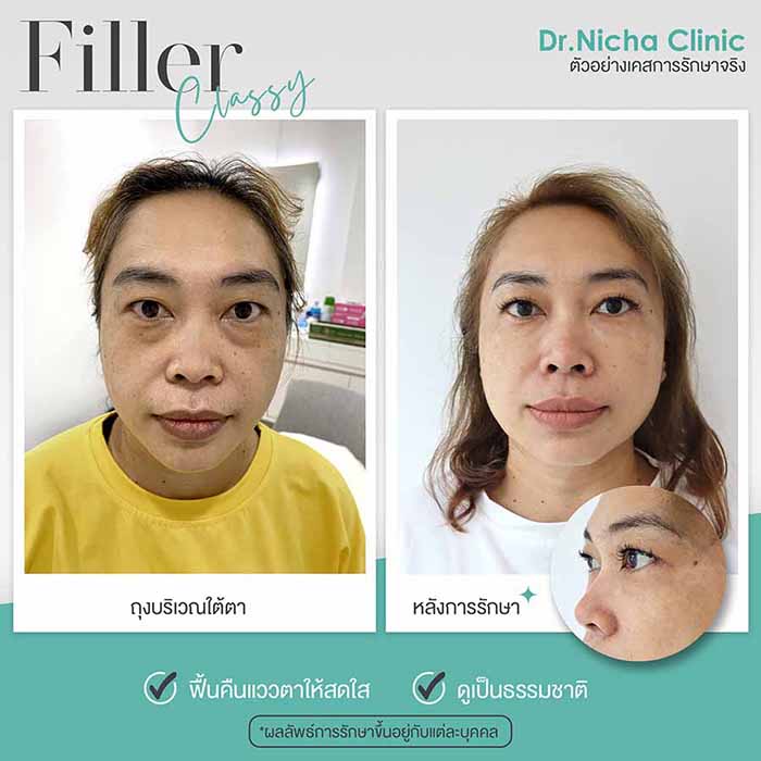 Filler Eyes case 5