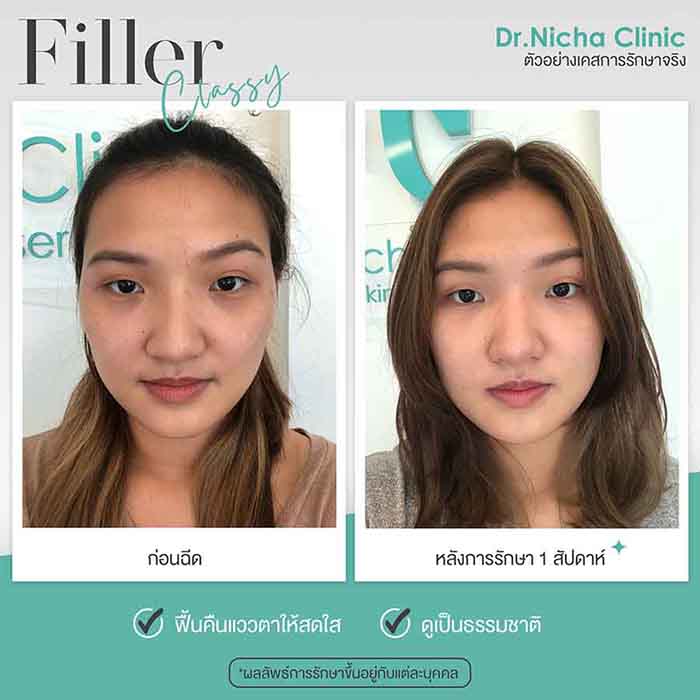 Filler Eyes case 6