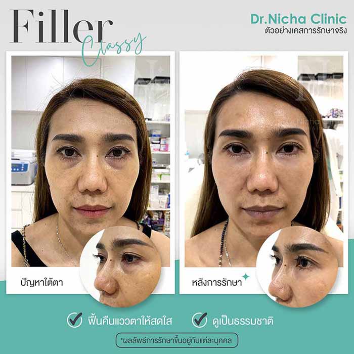 Filler Eyes case 7