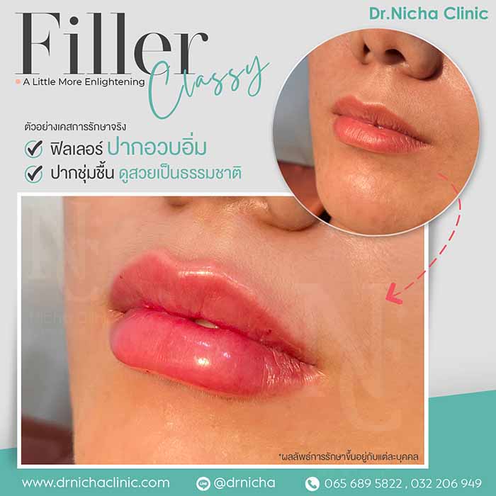Filler Lip case 3 1