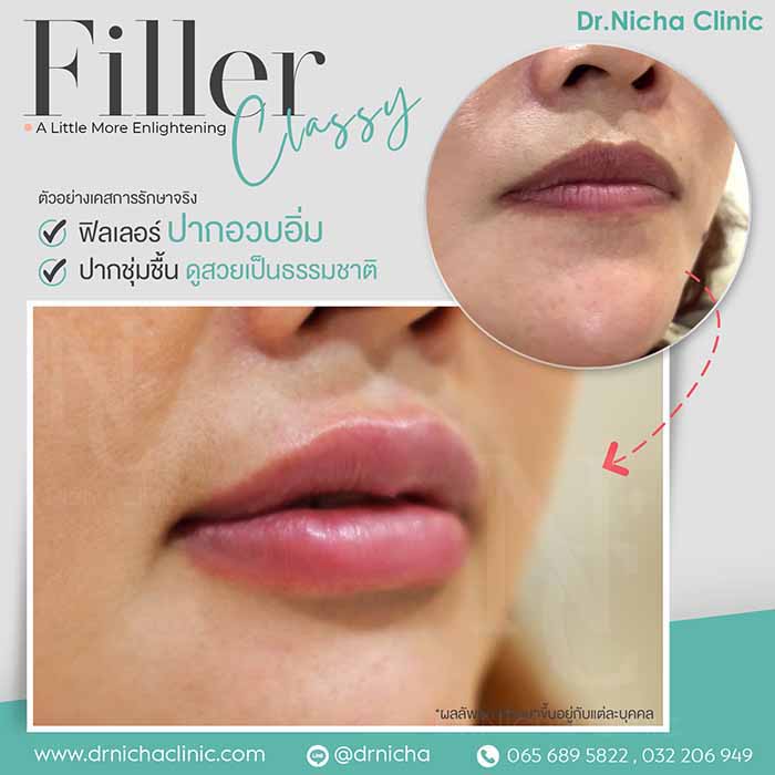 Filler Lip case 4 1