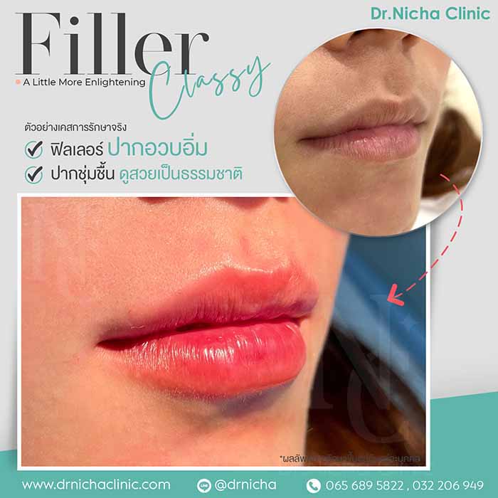 Filler Lip case 5 1