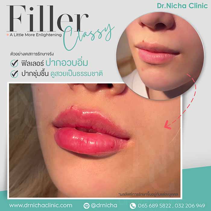 Filler Lip case 6 1