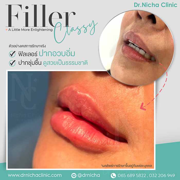 Filler Lip case 7 1