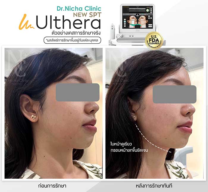 Ulthera case-2 ผลการทำ Ulthera กรอบหน้า