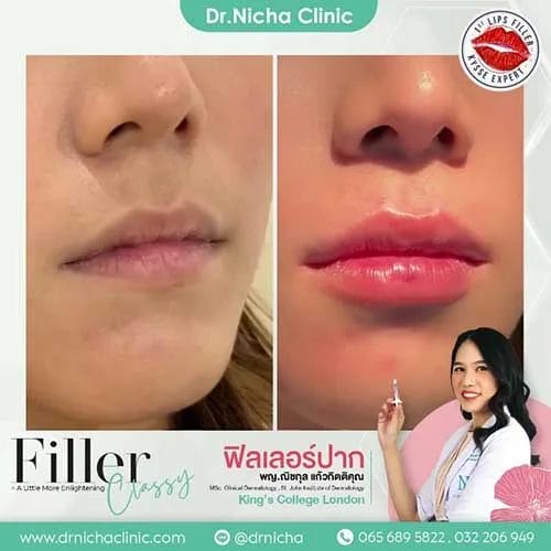 Video Lip Filler Case 1 Cover jpg