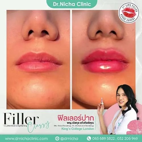 Video Lip Filler Case 3 Cover jpg