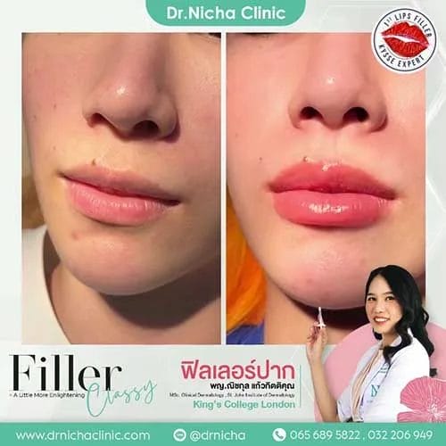 Video Lip Filler Case 4 Cover jpg