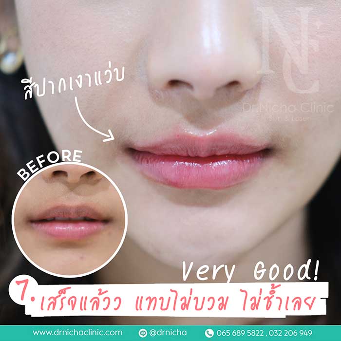 Filler_Lip_7 ฟิลเลอร์ปาก restylane kysse