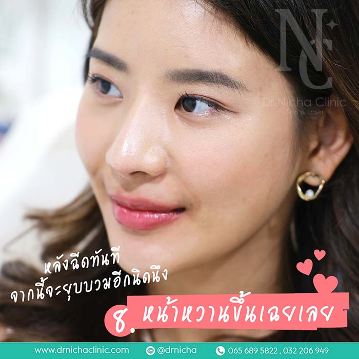 Filler_Lip_8 ฟิลเลอร์ปาก restylane kysse