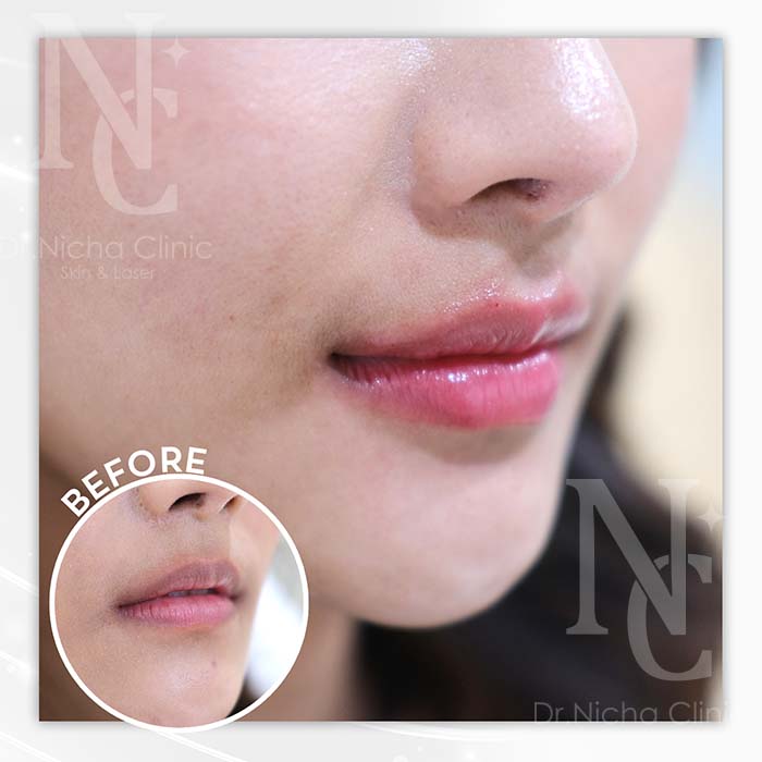 Filler_Lip_9 ฟิลเลอร์ปาก restylane kysse