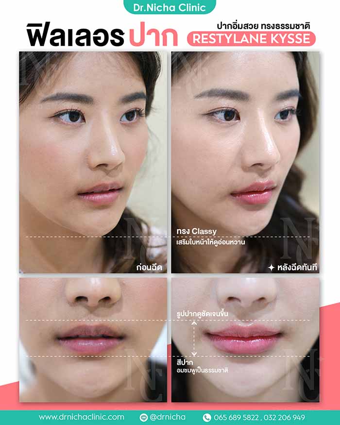 Review Filler lip_2 รีวิว ฟิลเลอร์ปาก restylane kysse
