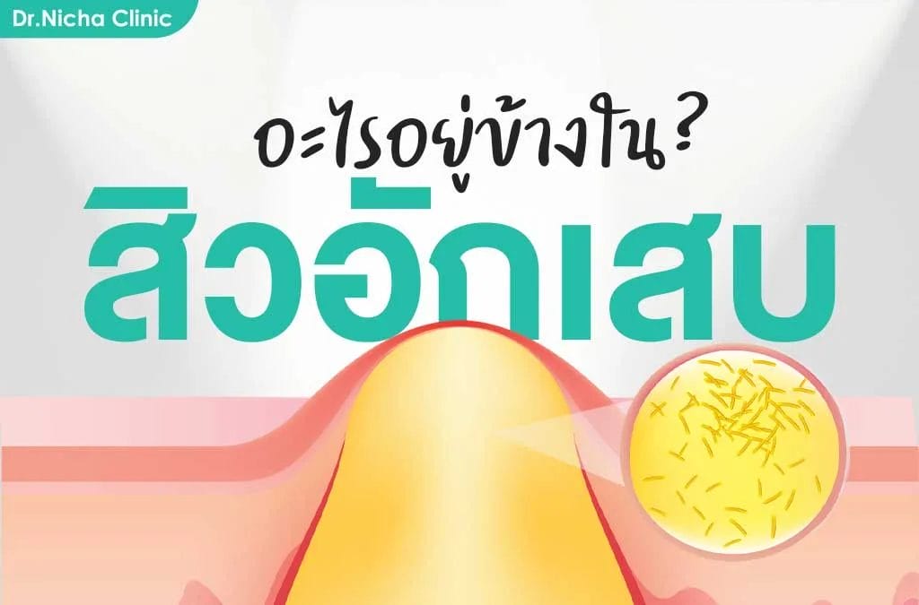 acne สิว สิวอักเสบ รักษาสิว เกิดจากอะไร