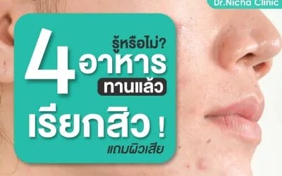 4 อาหารสิวที่ควรเลี่ยง ทานแล้วเรียกสิว!