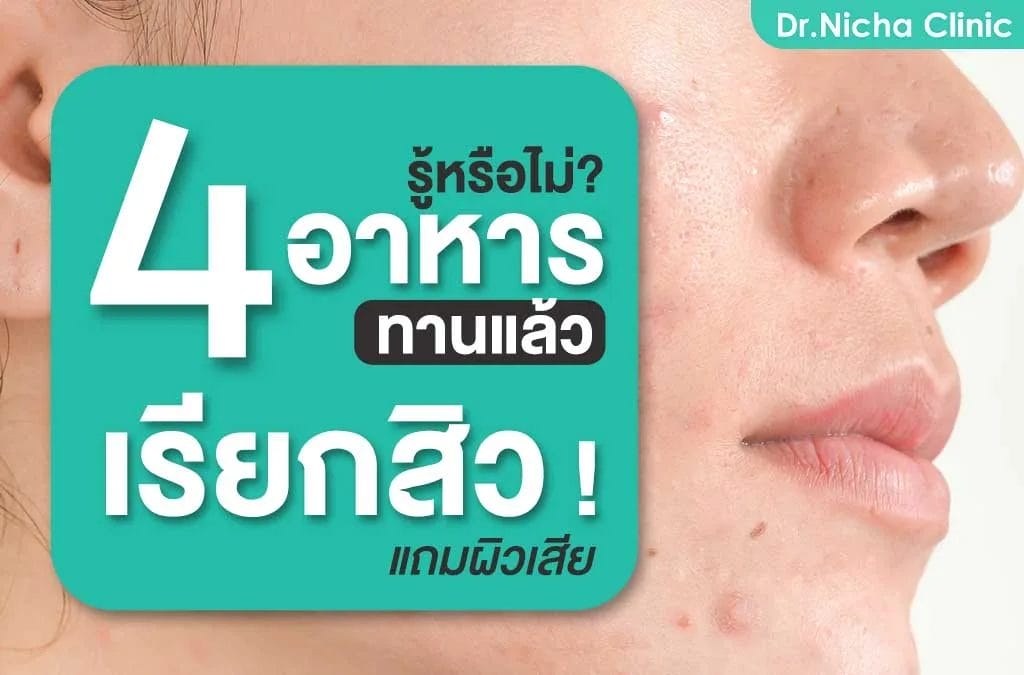 4 อาหารสิวที่ควรเลี่ยง ทานแล้วเรียกสิว!