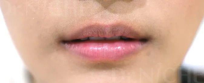 ก่อนการฉีดฟิลเลอร์ปาก