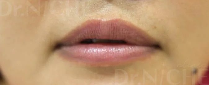 ก่อนการฉีดฟิลเลอร์ปาก