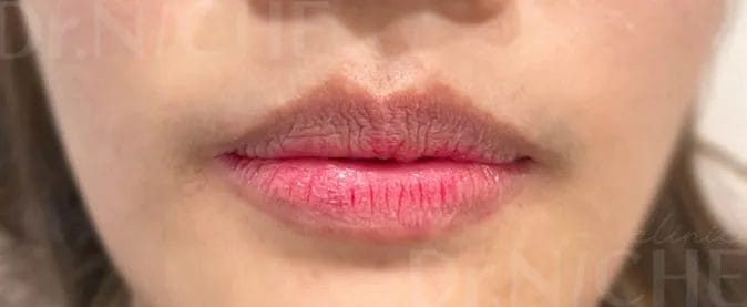 ก่อนการฉีดฟิลเลอร์ปาก