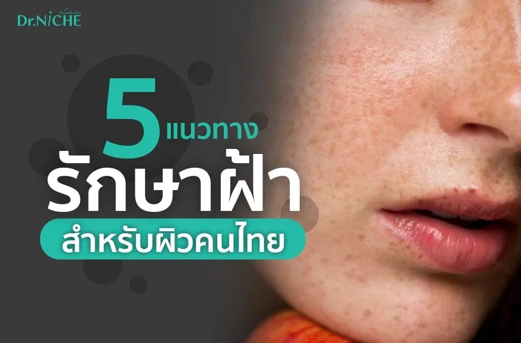 แนวทางรักษาฝ้า สำหรับผิวคนไทย