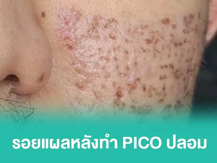 รอยหลุม หลังทำ pico laser ของปลอม