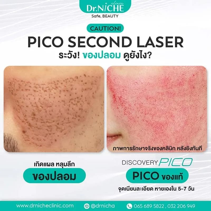 เปรียบเทียบ หลังการยิง Pico Laser ของปลอม กับของแท้
