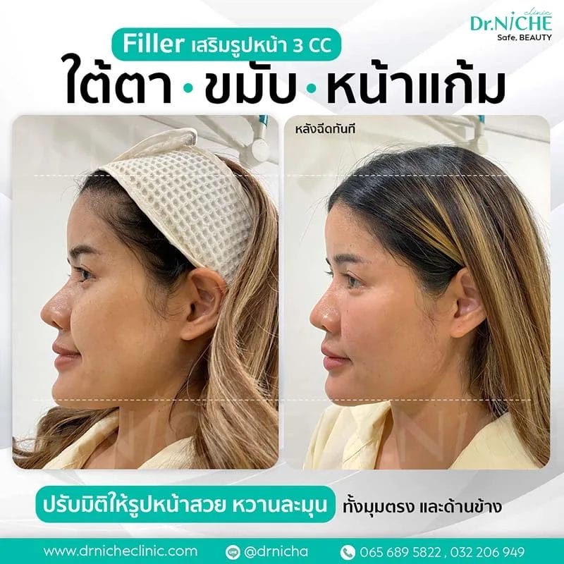 ฉีดฟิลเลอร์ ปรับรูปหน้า