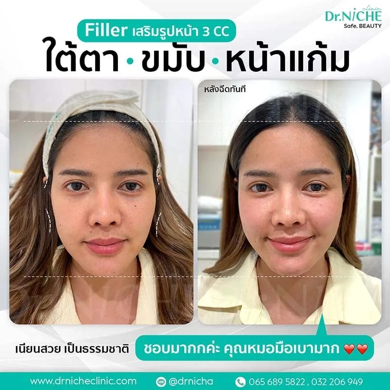 ฉีดฟิลเลอร์ ปรับรูปหน้า