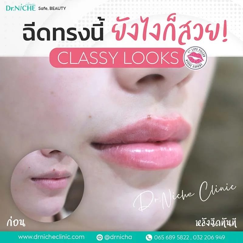 ฟิลเลอร์ปาก ทรง Classy