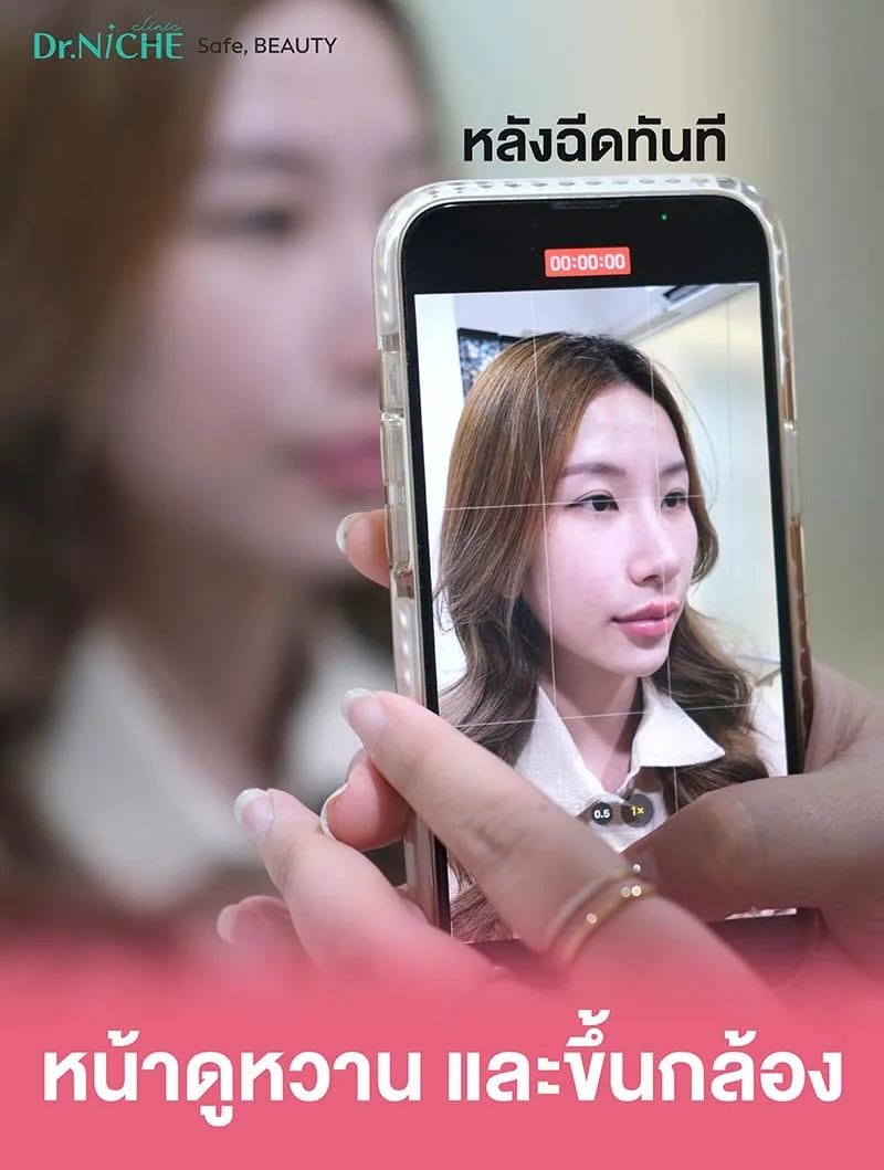หลังฉีดฟิลเลอร์ปาก