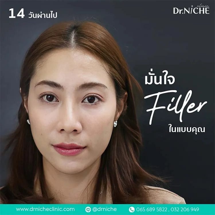 ฟิลเลอร์ ใต้ตา ปรับรูปหน้า