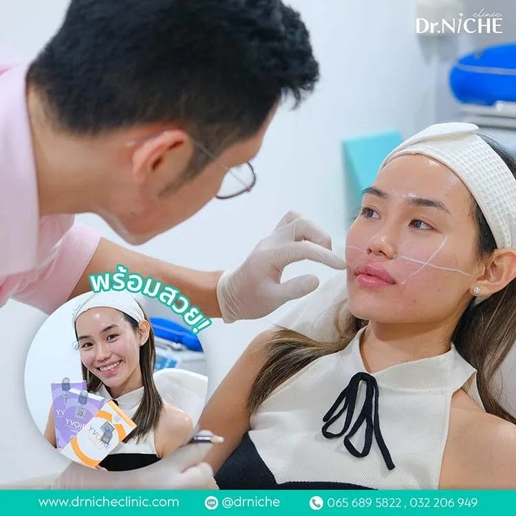 รีวิว ฟิลเลอร์ปาก