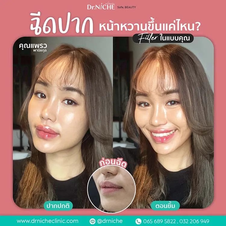 Filler Lip makeover 8 jpg