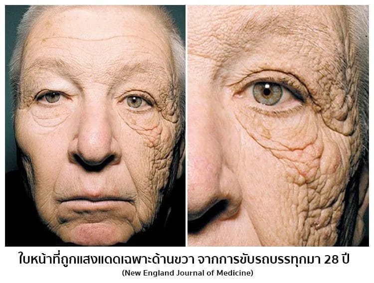 ใบหน้าที่ถูกแสงแดดด้านเดียว มาตลอด 28 ปี จากการขับรถบรรทุก