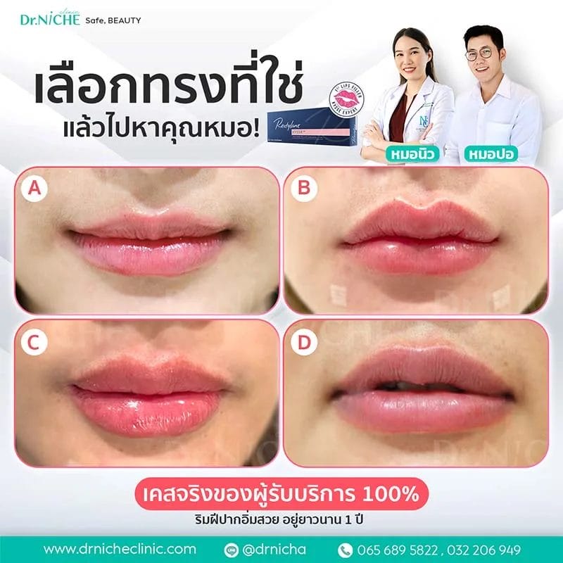 การฉีดฟิลเลอร์ปาก ในรูปปากแต่ละแบบ