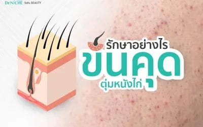 วิธีรักษาขนคุด ตุ่มหนังไก่ ให้กลับมาเรียบเนียน