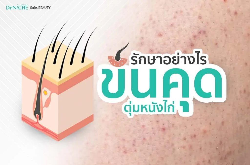 วิธีรักษาขนคุด ตุ่มหนังไก่ ให้กลับมาเรียบเนียน