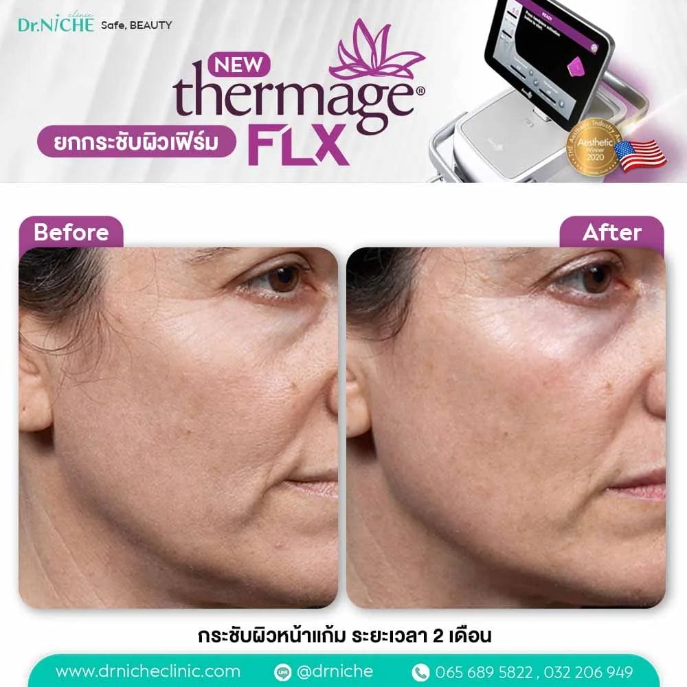 Thermage FLX Case 1 jpg