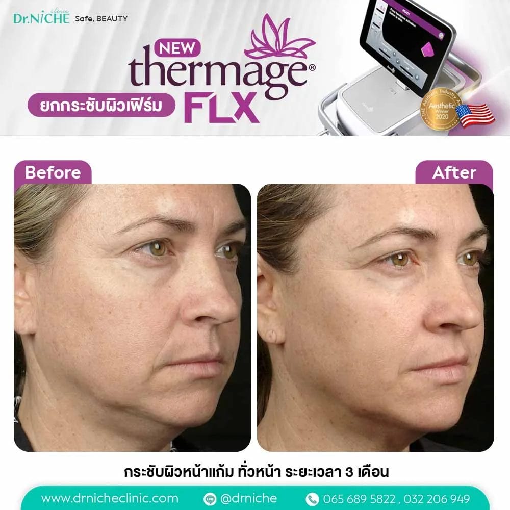 Thermage FLX ผลการรักษา ก่อนหลัง