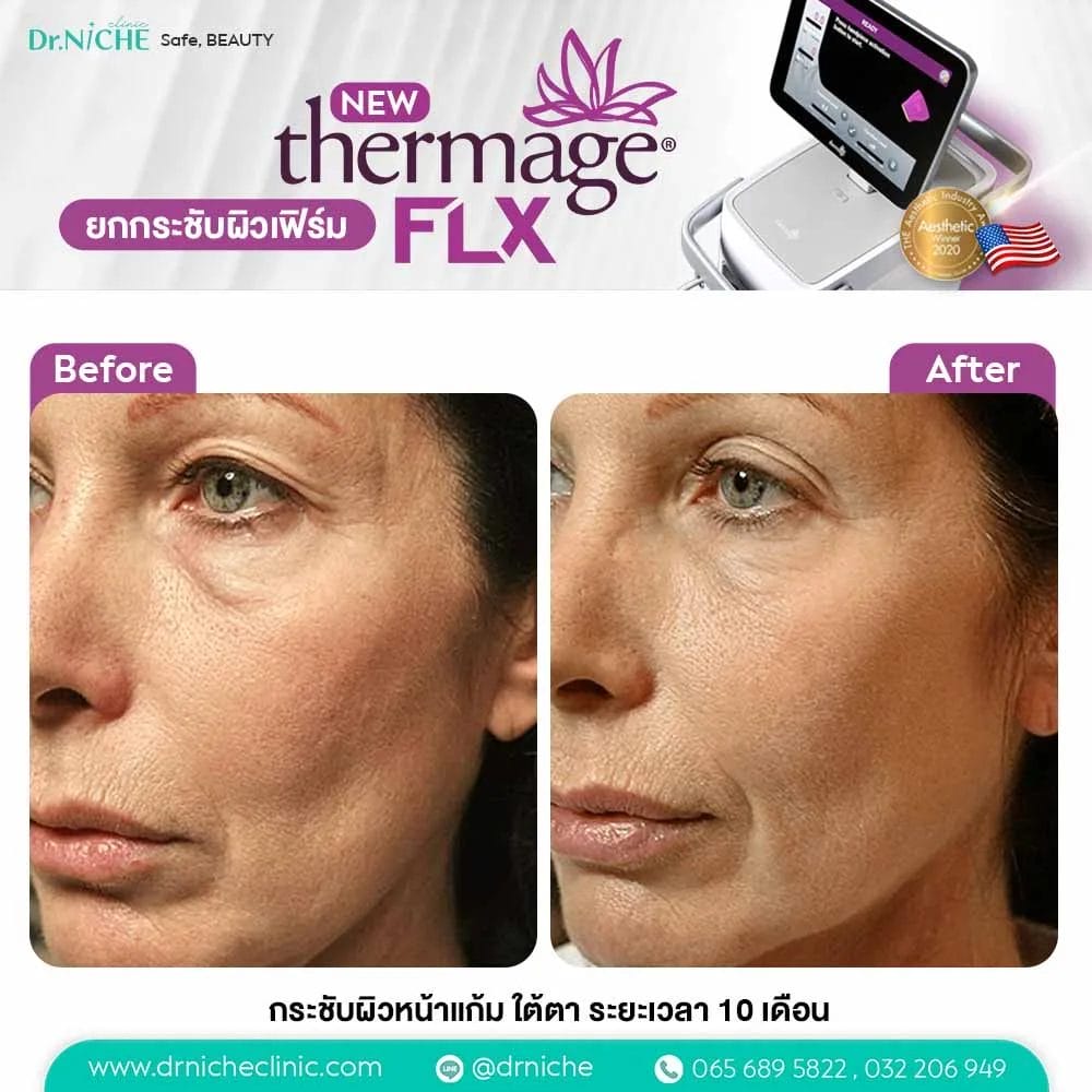 Thermage FLX ผลการรักษา ก่อนหลัง