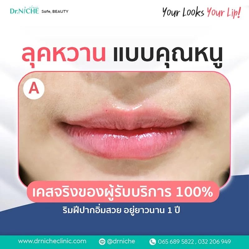 ทรงฟิลเลอร์ปาก แบบ Classy ดูหวานแบบลูกคุณหนู